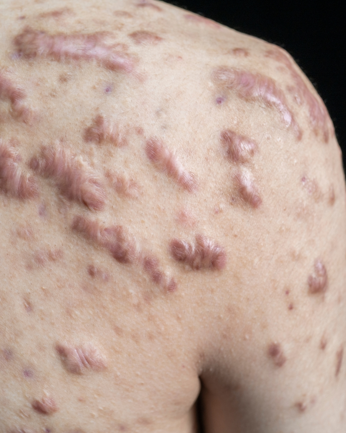 keloid-akne